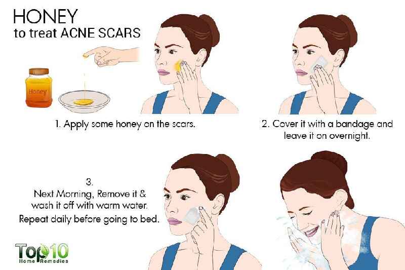 Does honey help acne