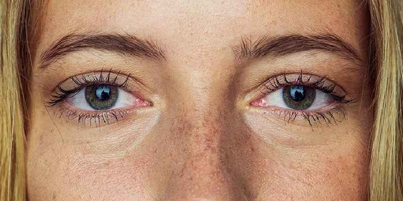 Does hydrocortisone help eye bags