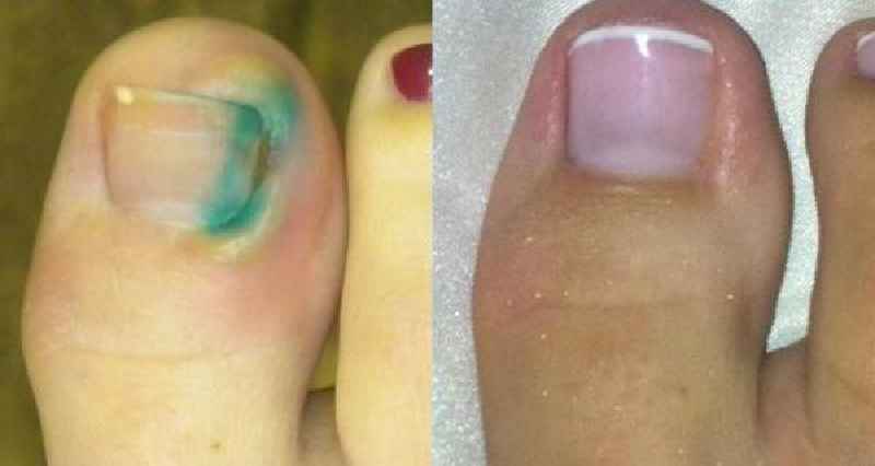 Does ice help ingrown toenails