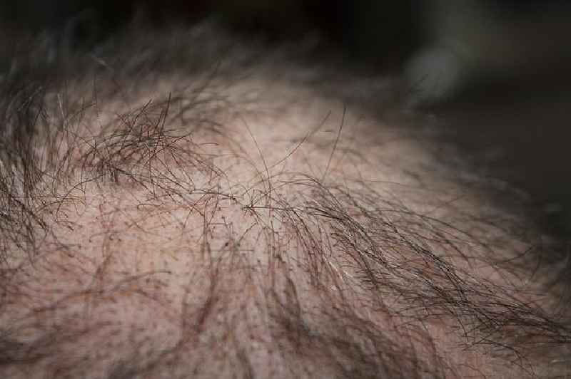 Does iron deficiency cause hairloss