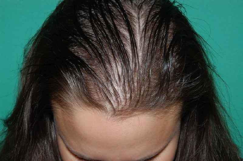 Does Iron Help postpartum hair loss