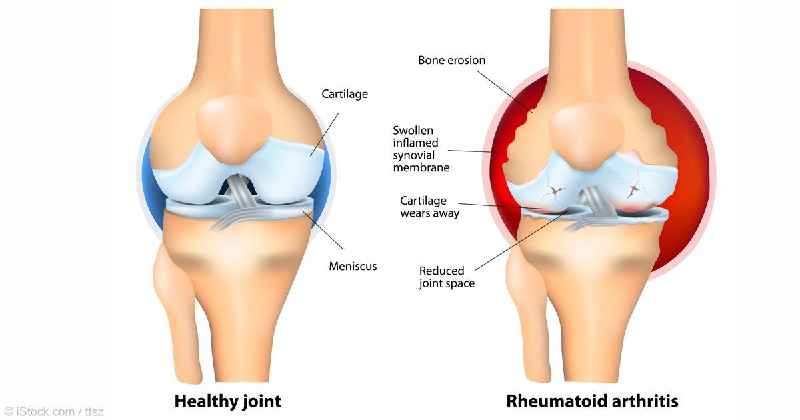 Does knee replacement help rheumatoid arthritis