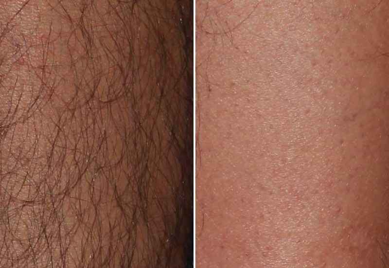 Does laser hair removal lighten skin