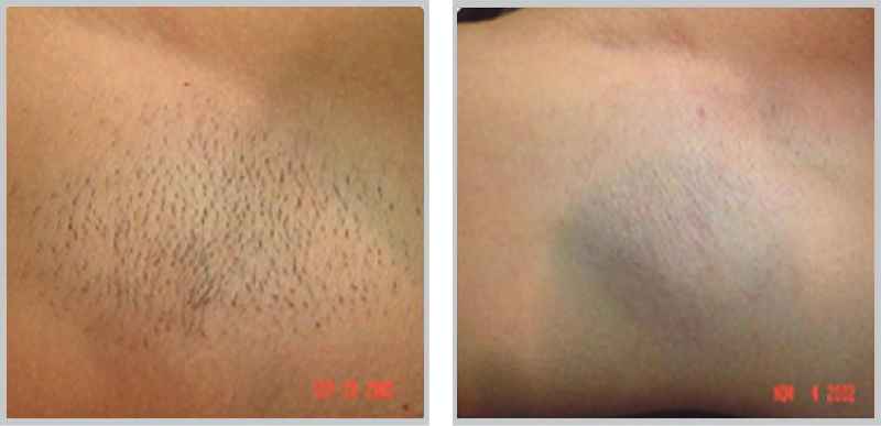 Does laser hair removal lighten skin