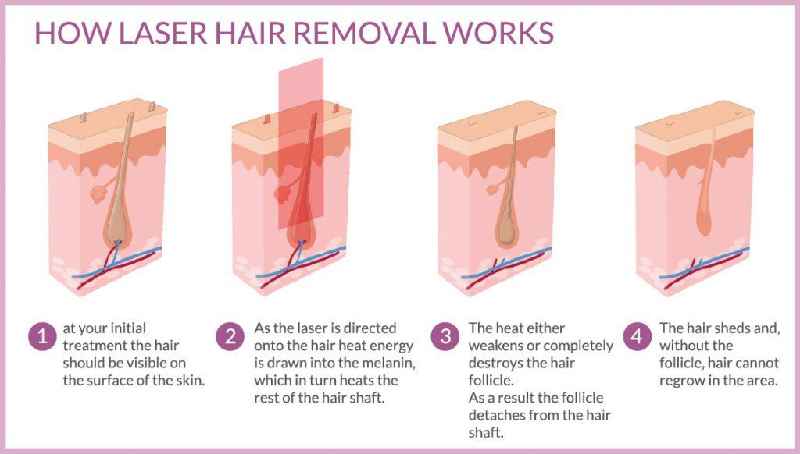 Does laser hair removal stop hair growth