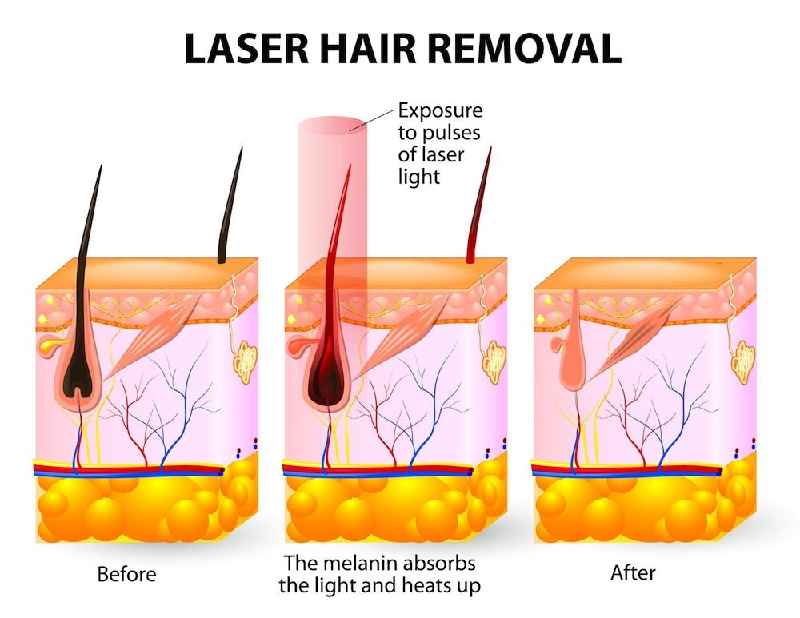 Does laser hair removal work on legs
