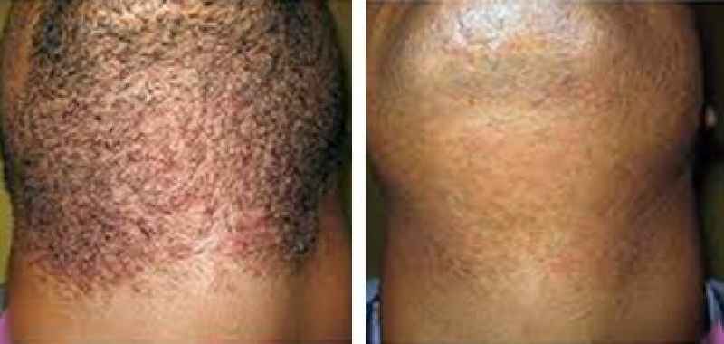 Does laser remove hair permanently