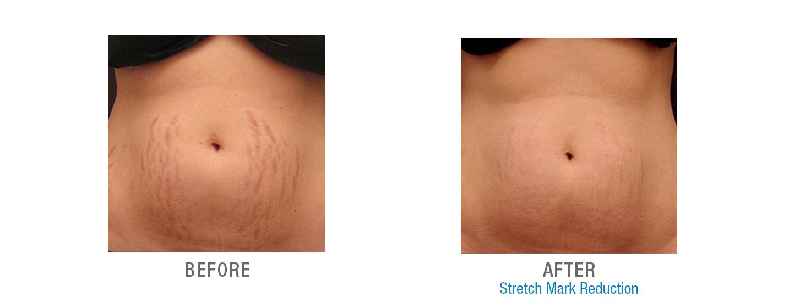 Does laser stretch mark removal work on old stretch marks