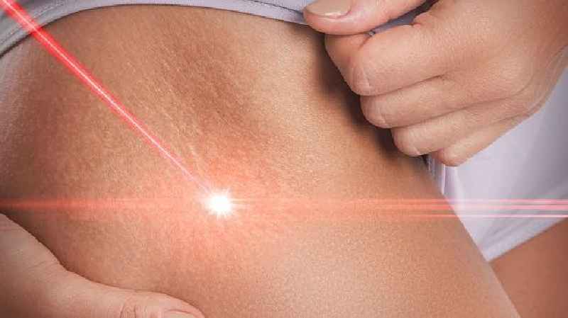 Does laser treatment for stretch marks work