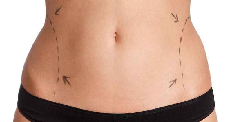 Does lipo work on belly fat