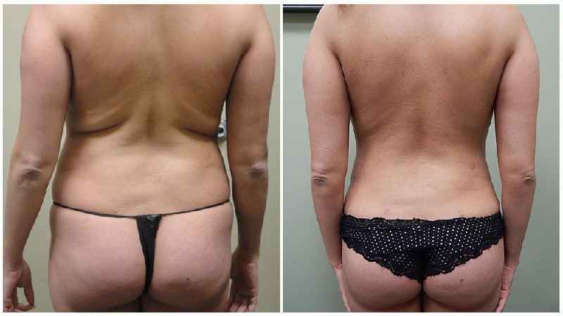 Does liposuction remove fat cells