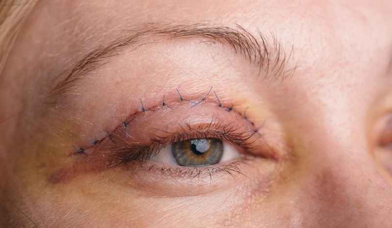 Does lower eyelid surgery remove wrinkles