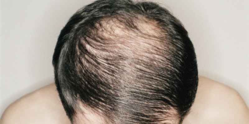 Does lupus cause hair loss