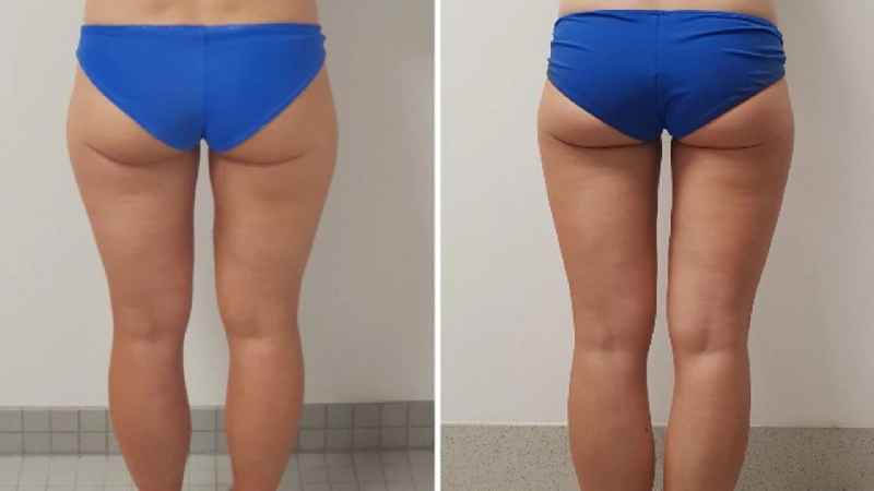 Does massaging cellulite really work