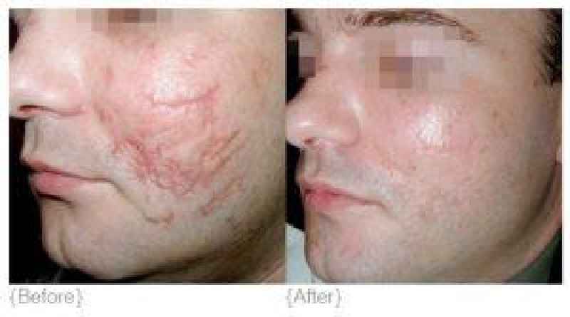 Does Mederma work on pitted scars