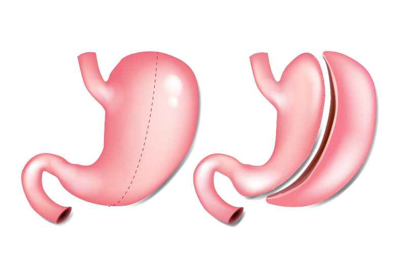Does Medicaid cover gastric sleeve