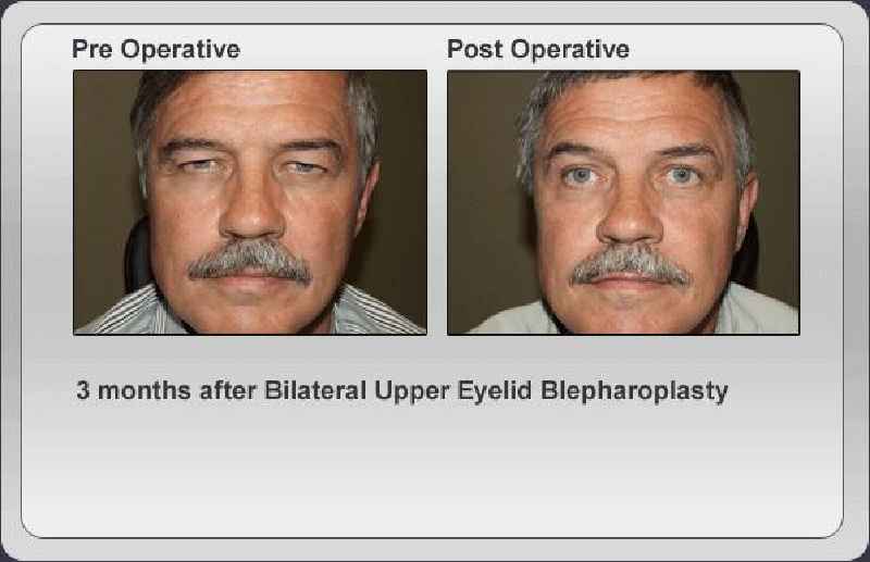 Does Medicare cover blepharoplasty eyelid surgery and brow lift