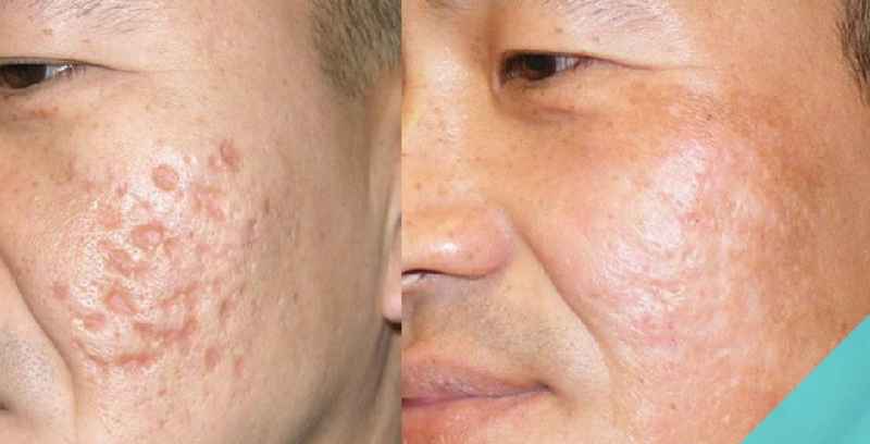 Does micro needling help with acne scars