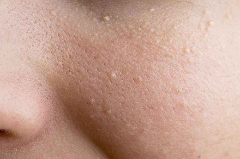 Does microdermabrasion help Crepey skin