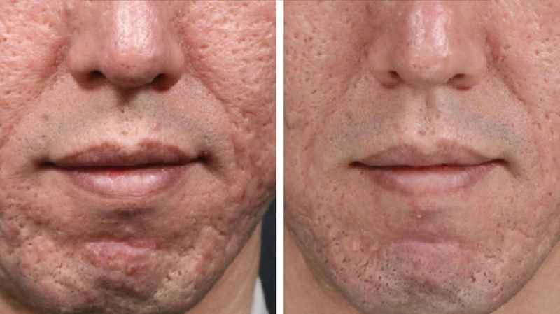Does microneedling get rid of acne scars permanently