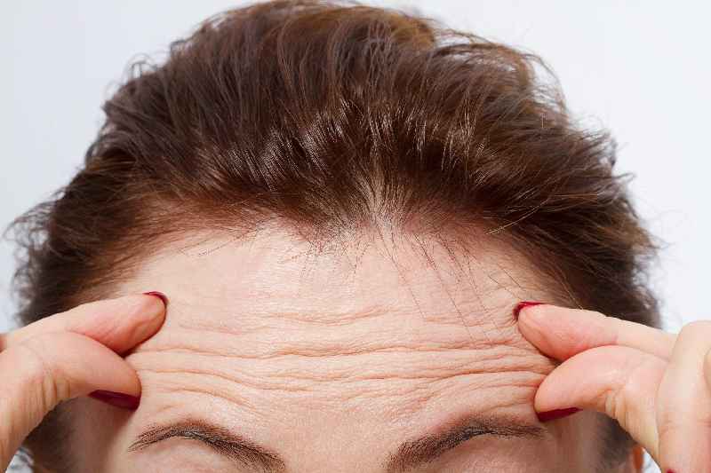 Does Microneedling get rid of forehead wrinkles
