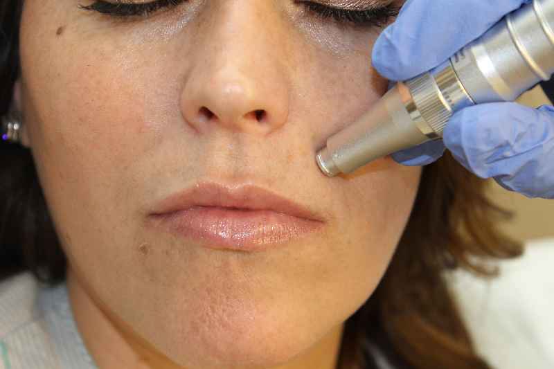 Does microneedling help acne scars