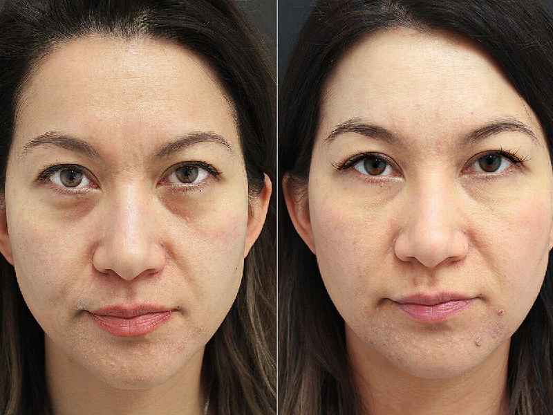Does Microneedling help with under eye bags