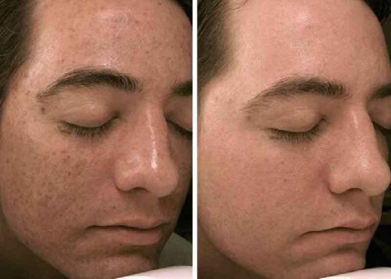 Does microneedling with PRP plump skin