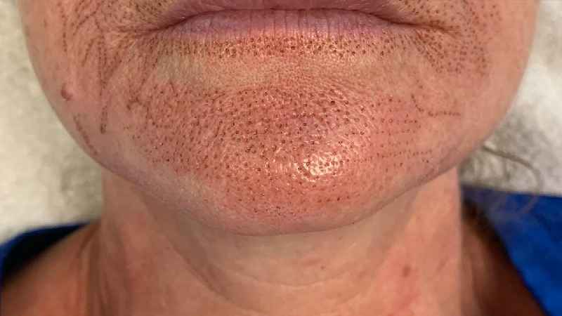 Does Microneedling work on lip lines