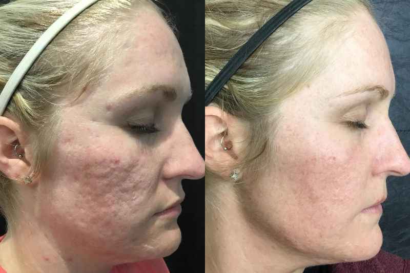 Does microneedling work on old scars