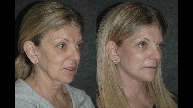 Does mini facelift require general anesthesia