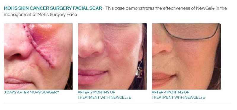 Does MSM cream work for scars