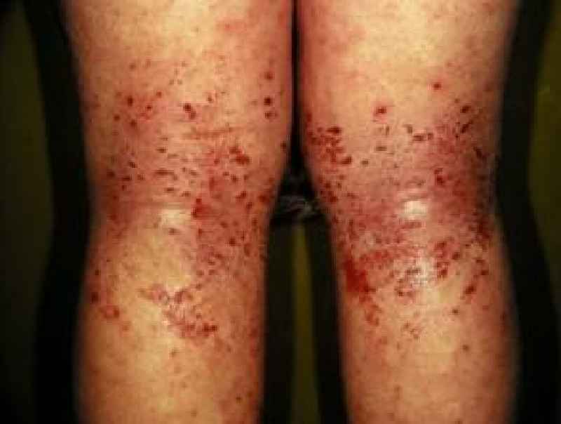 Does Neosporin help with eczema
