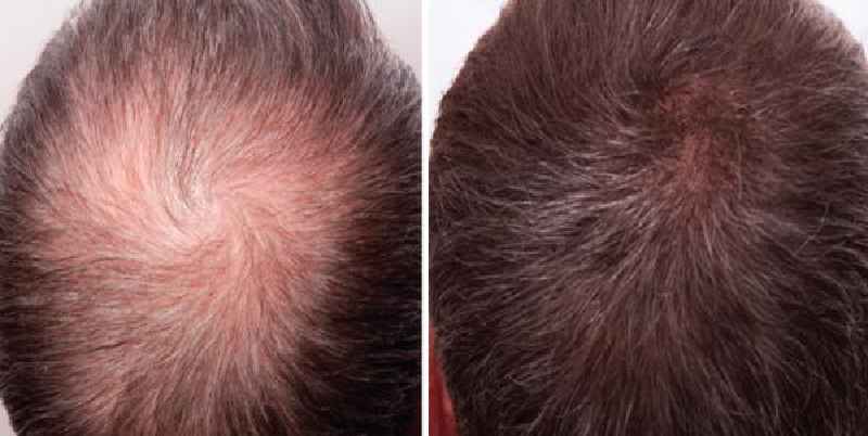 Does oiling cause hairloss