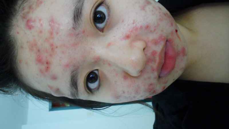 Does panthenol cause acne