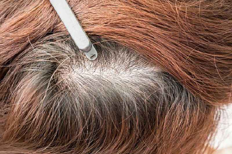 Does PCOS cause hair loss