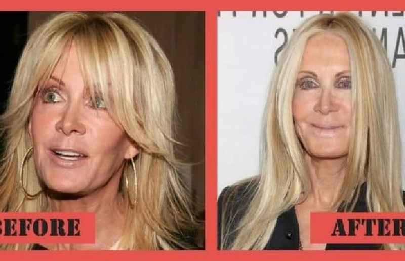 Does plastic surgery look worse as you age