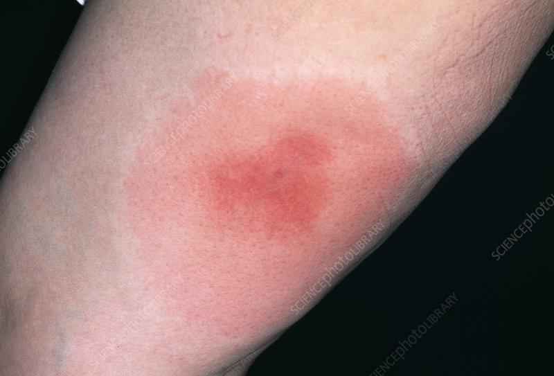 Does polysporin treat infection