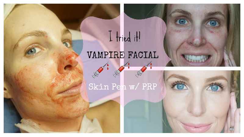 Does PRP make skin thicker