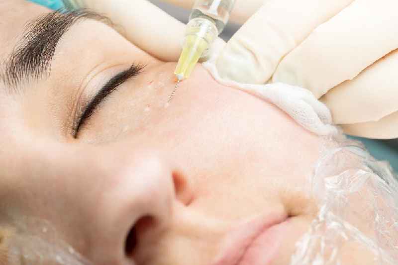 Does PRP work for under eye bags