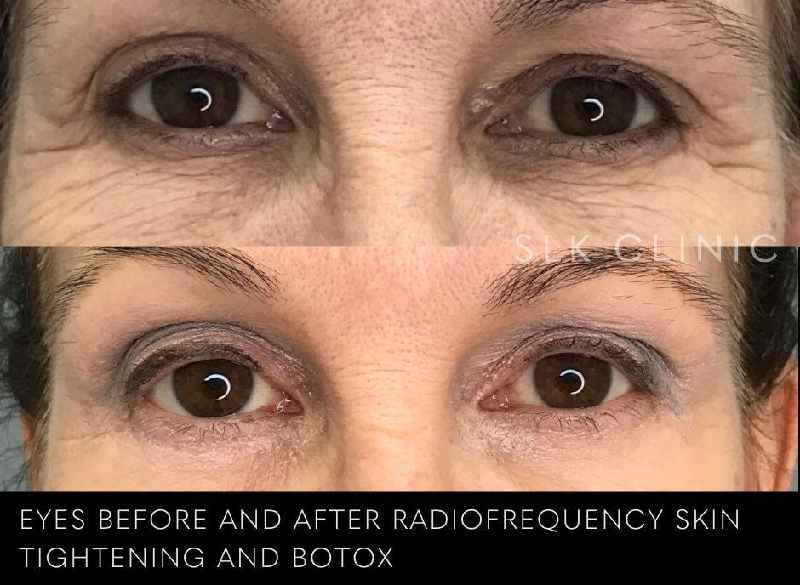 Does PRP work on crows feet