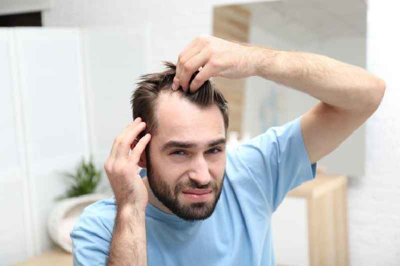 Does receding hairline lead to baldness