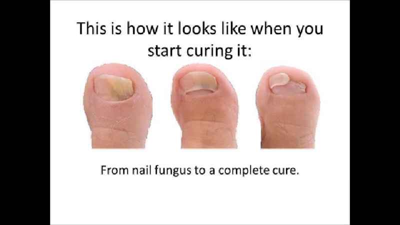 Does removing a toenail cure fungus