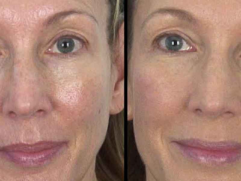 Does retinol reduce pore size