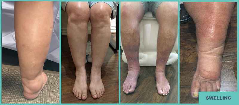 Does sclerotherapy cause circulation problems