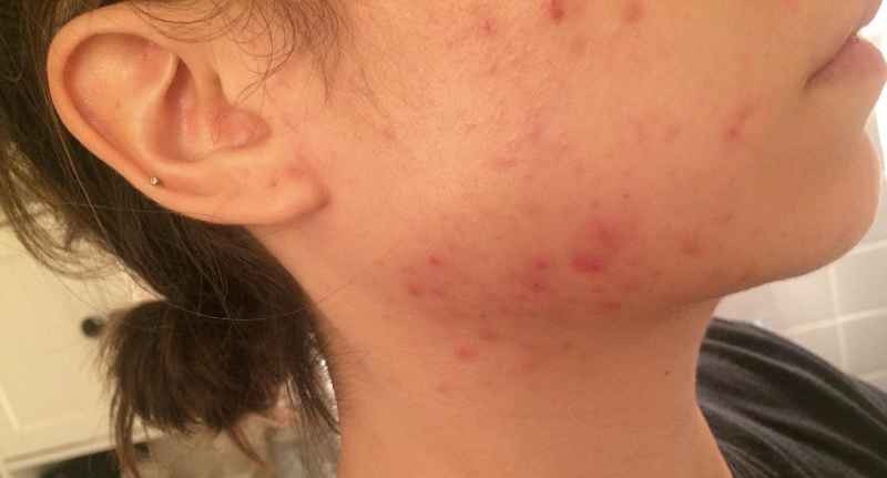 Does stress cause acne