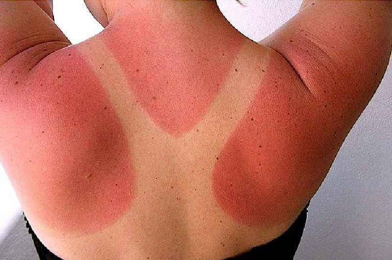 Does sunscreen protect sunburned skin