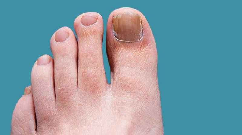 Does toenail fungus hurt