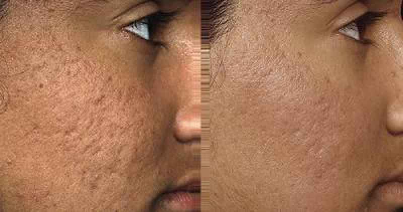Does turmeric reduce pores