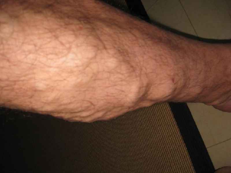 Does varicose veins affect the heart